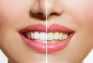  Pleasant Hill Cosmetic Dentist | teeth whitening, Opalescence | Diablo Valley Dentistry